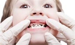سلامت دهان و دندان در کشور مطلوب نیست